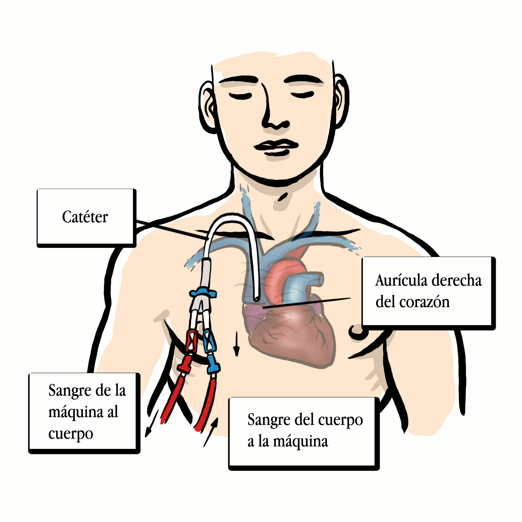 Catéter tunelizado Catéter tunelizado