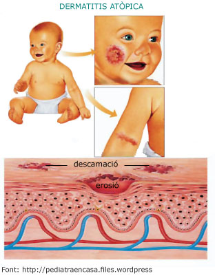 Dermatitis atòpica Dermatitis atòpica