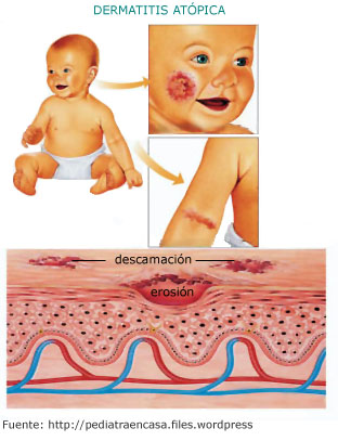 Dermatitis at&oacute;pica y zonas de erosi&oacute;n