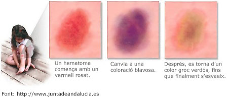 Hematomes Diferents fases en un hematoma o blau