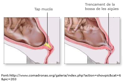 Tap mucós i trencament de la bossa de les aigües Tap mucós i trencament de la bossa de les aigües