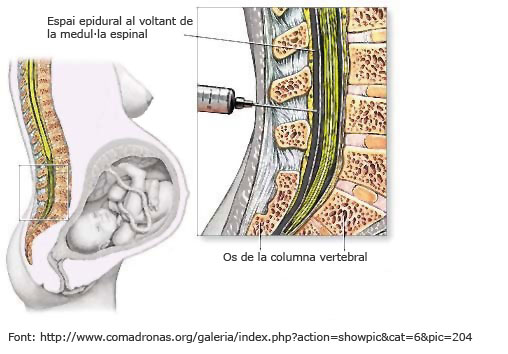 Espai epidural al voltant de la medul&middot;la espinal
