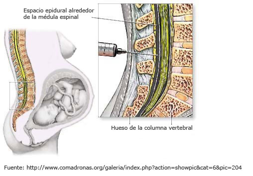Espacio epidural alrededor de la m&eacute;dula espinal