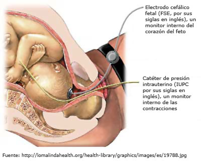 Registro cardiotocogr&aacute;fico interno