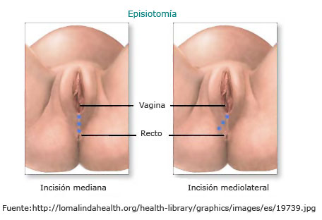 Episiotom&iacute;a: incisi&oacute;n mediana e inci&oacute;n mediolateral