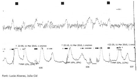 Gràfic registre cardiotocogràfic Gràfic registre cardiotocogràfic
