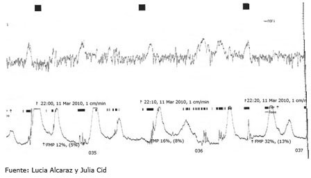 Gr&aacute;fico registro cardiotocogr&aacute;fico
