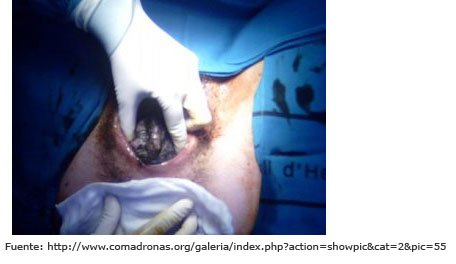 Aplicaci&oacute;n gasas calientes en el perin&eacute;