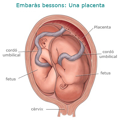Embaràs bessons: una placenta Embaràs bessons en una placenta