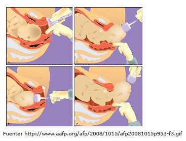 Extracci&oacute;n del beb&eacute; con ventosa