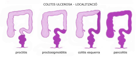 Colitis ulcerosa - localitzaci&oacute;
