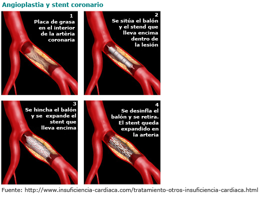 Angioplastia y stent coronario pasos de una Angioplastia