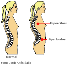 Hiperlordosi Hiperlordosi