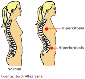 Hiperlordosis Imagen Hiperlordosis