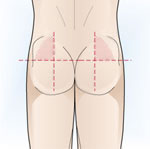 Zonas de inyecci&oacute;n en el gl&uacute;teo