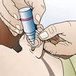 Administración gotas óticas administración gotas óticas estirando ligeramente oreja hacia arriba