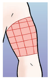 Zona punción en el antebrazo zona inyección: antebrazo